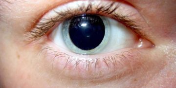 Eye exam may predict Alzheimer’s