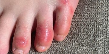 ‘Covid toes, ’ other rashes latest possible rare virus signs